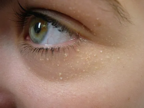 trị mụn thịt tại nhà hiệu quả nhất