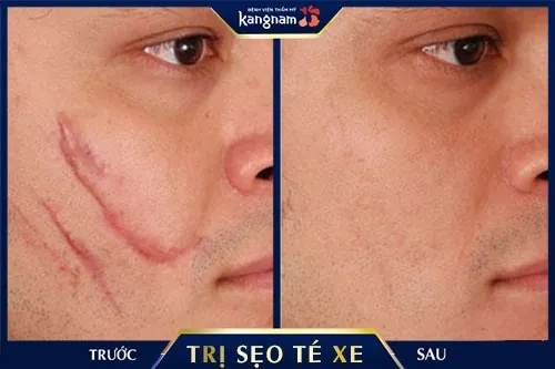 Kết quả khách hàng sau trị sẹo ngã xe tại Kangnam