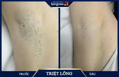 Chỉ sau 3 buổi trị liệu, vùng lông nách của chị An (Hòa Bình) đã được xử lý hoàn toàn, không mọc trở lại triệt lông