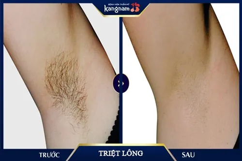 Chị Nga (Thái Bình) chia sẻ về nỗi khổ suốt ngày phải nhổ lông nách khiến vùng da tại đây thâm sần, xấu xí. Sau khi triệt lông vĩnh viễn tại Kangnam, chị tự tin hơn hẳn khi diện những bộ cánh sexy triệt lông nách