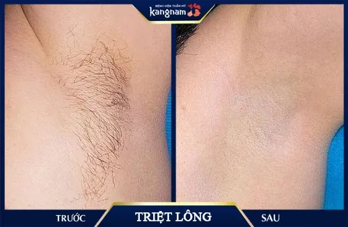 Sau khi trải qua 3 buổi triệt lông bằng công nghệ Diode Laser, mình đã hết sạch lông và hoàn toàn không cần chăm sóc quá nhiều cho vùng da này. Lỗ chân lông se khít lại và tình trạng thâm xỉn màu trước đây cũng giảm hẳn triệt lông nách vĩnh viễn