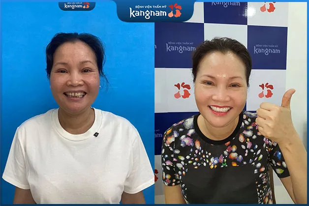 Bác Thoa vô cùng hài lòng với hàm răng sau tẩy trắng