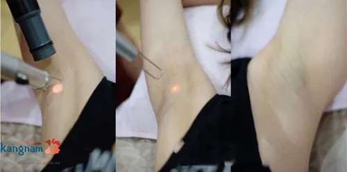 bắn laser trị thâm nách