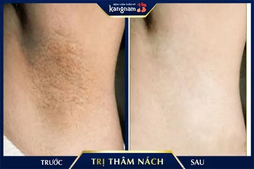 bắn laser trị thâm nách 