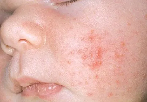 Trường hợp bé bị mụn cơm ở mặt mụn cóc ở mặt