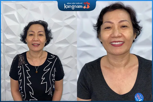 Cô Hoa rạng rỡ sau khi tẩy trắng răng