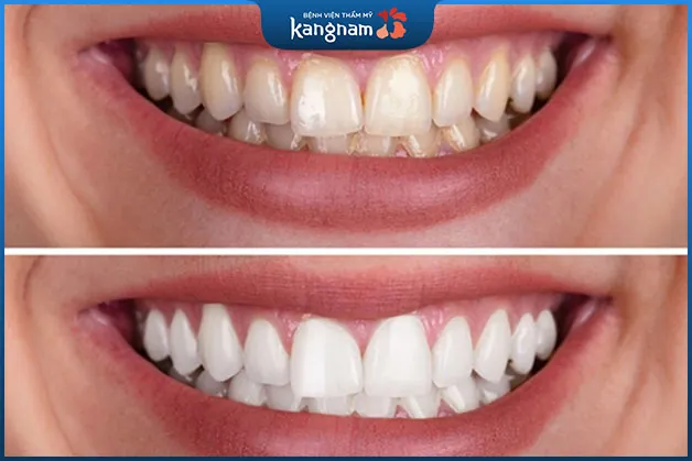 Kiêng các thực phẩm đậm màu sẽ giúp răng trắng sáng tốt hơn