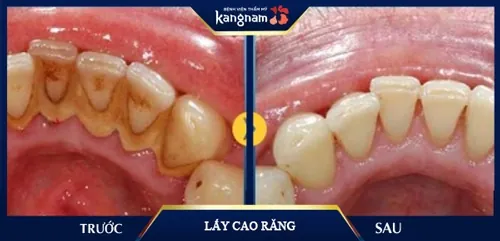 chảy máu chân răng sau khi lấy cao răng
