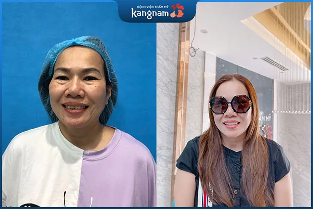 Cô Thoa hạnh phúc với hàm răng mới