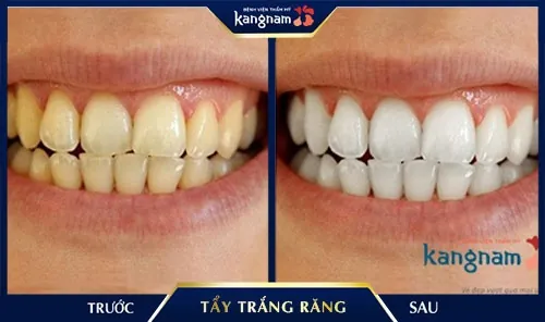 đánh răng bằng than hoạt tính có tốt không đánh răng bằng than hoạt tính có tốt không