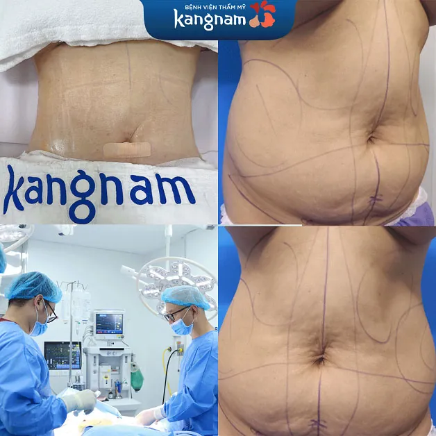 Khắc phục mỡ bụng ngay sau 90 phút, thay đổi vòng 2 đẹp như mơ