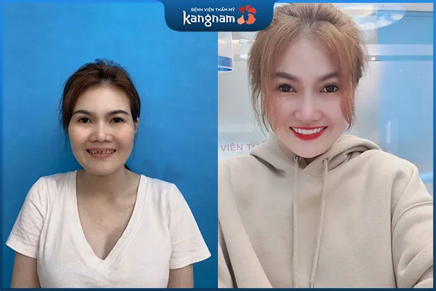 Khách hàng nở nụ cười tự tin cùng hàm răng trắng sáng