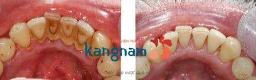 lấy cao răng có tốt không