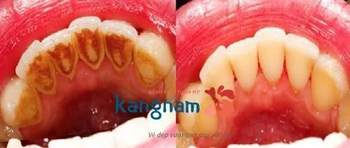 lấy cao răng như thế nào