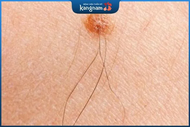 Hầu hết những vị trí nốt ruồi trên cổ có màu tối và mọc lông là điềm xui