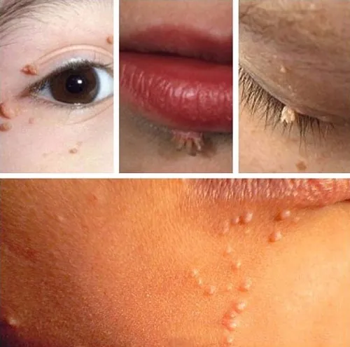 Tình trạng mụn cóc trên mặt với nhiều vị trí dưới mắt, trên môi, mi mắt,... mụn cơm ở mặt