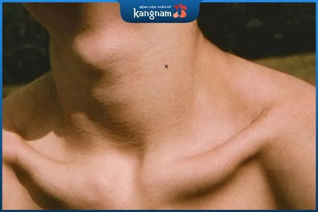 Nam giới sở hữu nốt ruồi trên cổ thường có tính nóng vội 