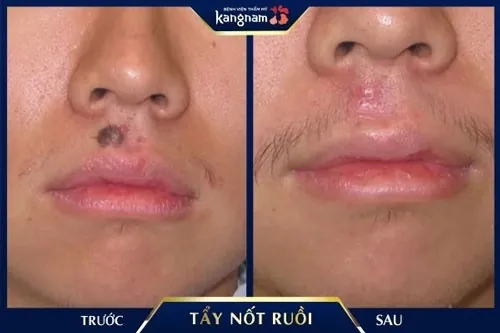 nốt ruồi giữa nhân trung nam