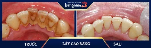 răng bị ê buốt sau khi lấy cao răng