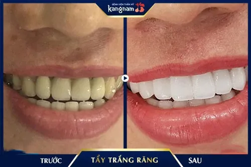 than tre trắng răng than tre trắng răng