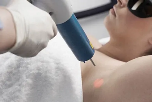 trị thâm nách bằng laser review