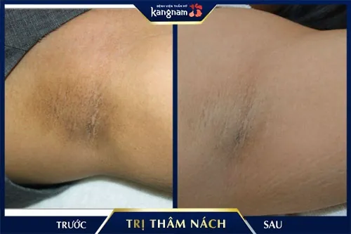 trị thâm nách bao nhiêu tiền 