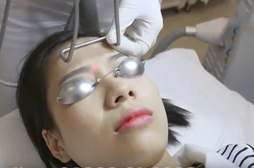 Triệt gọn lông mày ở vị trí ấn đường là phương pháp được nhiều người lựa chọn