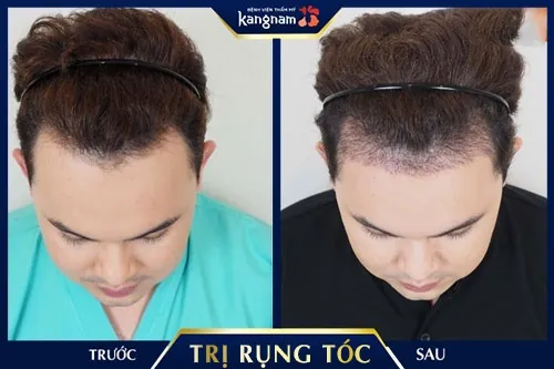 dầu gội trị rụng tóc sau sinh 