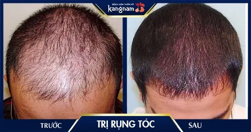 chữa rụng tóc 