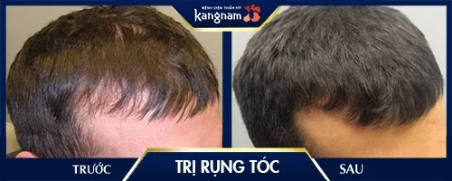 trị rụng tóc 