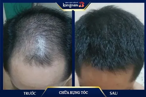 chăm sóc tóc với nha đam