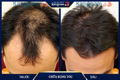 dưỡng tóc với vitamin e