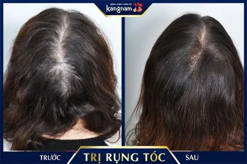trị rụng tóc bằng muối