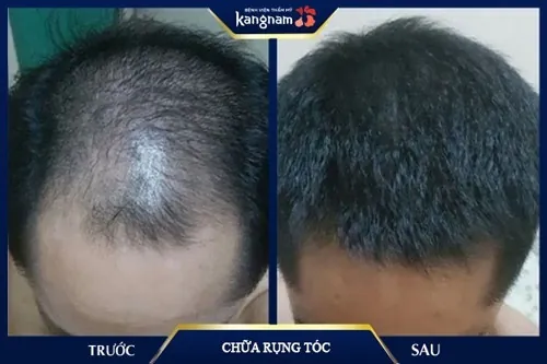 gội đầu bằng vitamin e