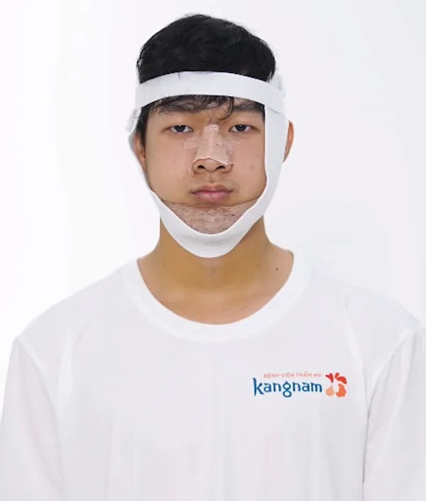 Phẫu thuật mặt lệch cần thời gian hồi phục khoảng từ 2-4 tuần