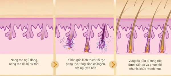 nguyên nhân gây rụng tóc ở nam giới nguyên nhân gây rụng tóc ở nam giới