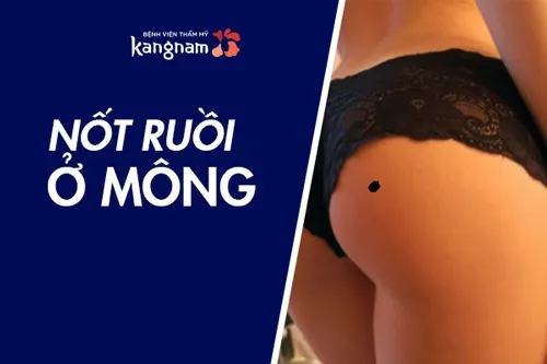Nốt ruồi ở mông phụ nữ và đàn ông nói lên điều gì?