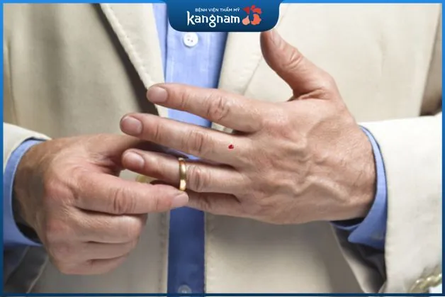 Nốt ruồi son ở ngón giữa đàn ông là đặc điểm quý tướng mà ai cũng muốn sở hữu