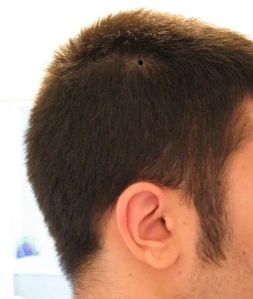 nốt ruồi trên đầu đàn ông