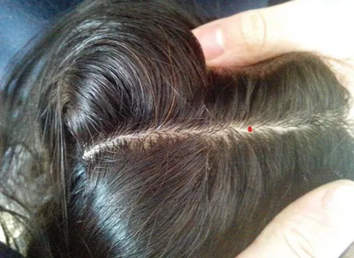 nốt ruồi trên đầu trong tóc 
