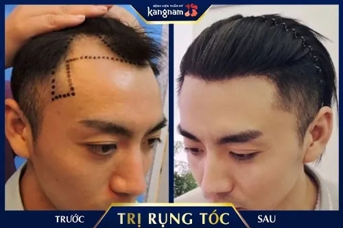 rụng tóc sau sinh nên uống gì