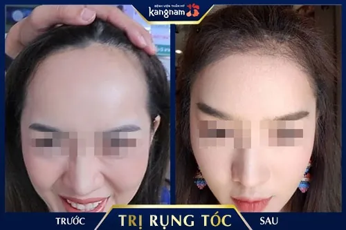 rụng tóc sau sinh phải làm sao