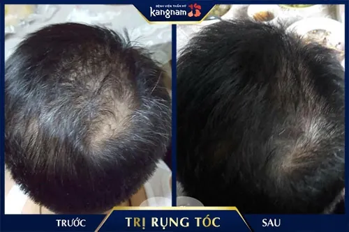 tác dụng gội đầu bằng bồ kết