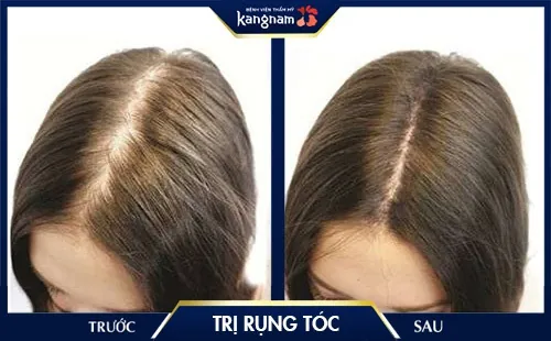 cách trị rụng tóc 