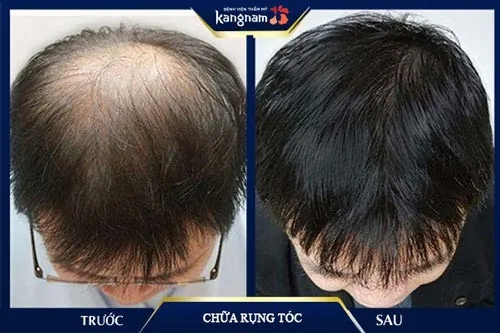 vitamin e dưỡng tóc