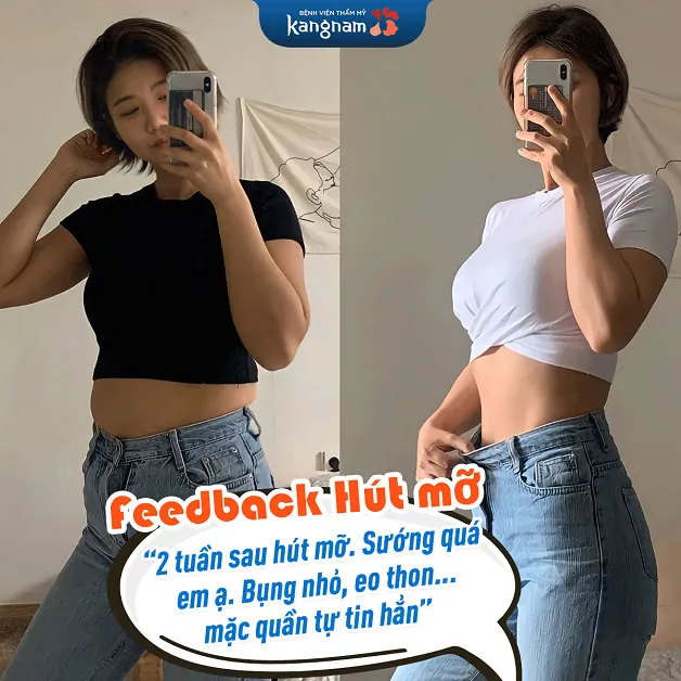 Hút mỡ sau 2 tuần: Vòng eo gọn gàng 