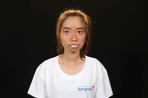 ảnh trước phẫu thuật nguyễn thị huê ảnh trước phẫu thuật nguyễn thị huê