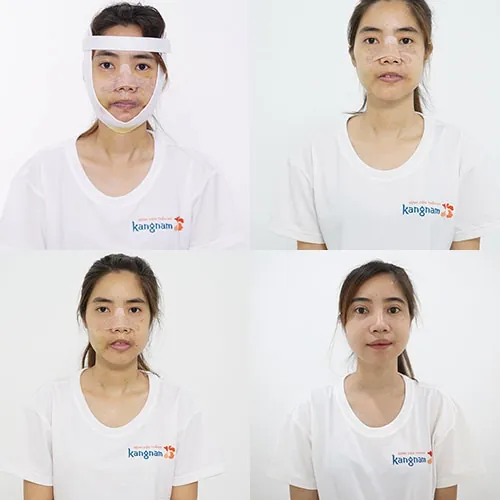 quá trình hồi phục nguyễn thị huê tại kangnam quá trình hồi phục nguyễn thị huê tại kangnam