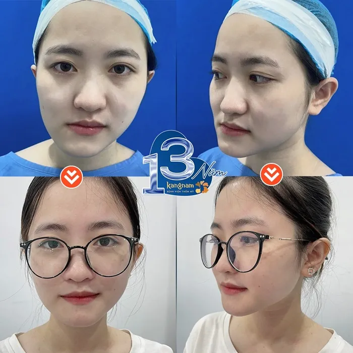 Khách hàng cằm lẹm, mất cân đối sau trượt cằm mặt đẹp thon gọn tự nhiên