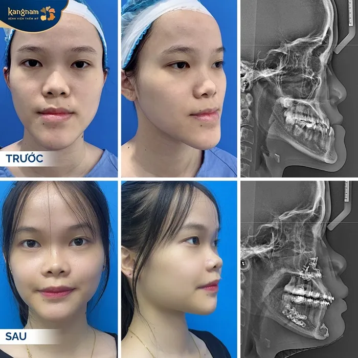 Kỹ thuật trượt cằm được thực hiện bằng sự hỗ trợ của thiết bị hiện đại